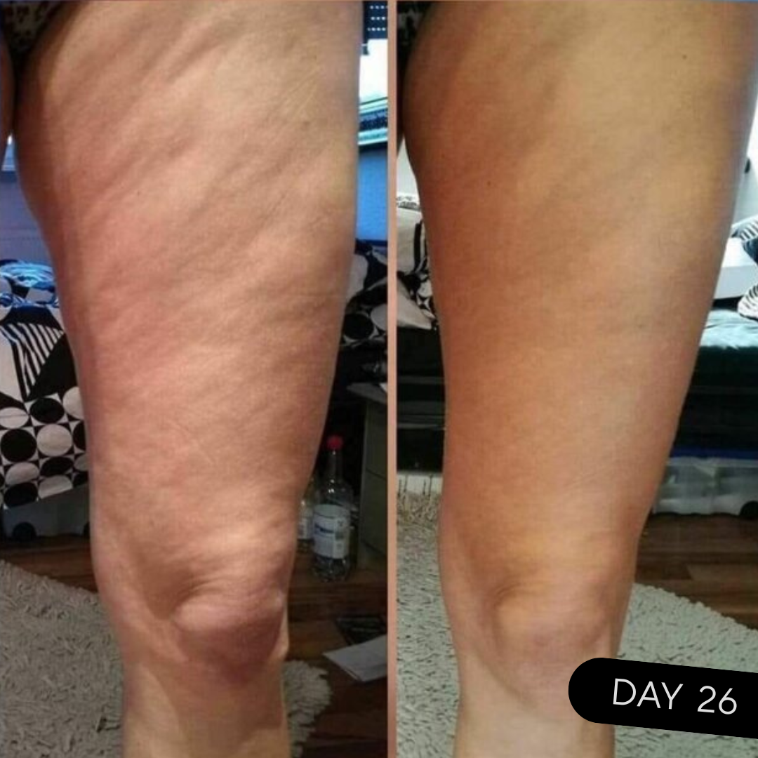 SmoothRoll 360 – Lymphatic Massage & Body Roller